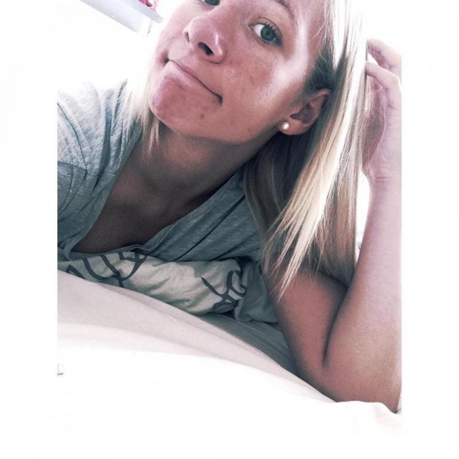 Acne selfie. Photo 11