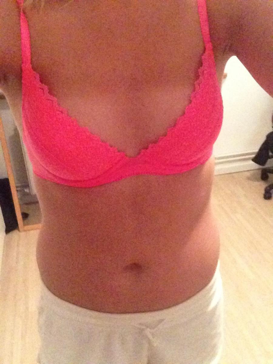 Acne selfie. Photo 30