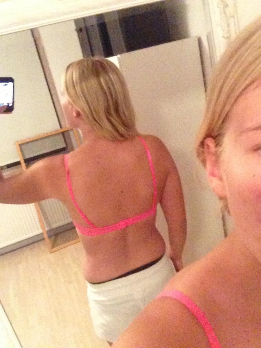 Acne selfie. Photo 32