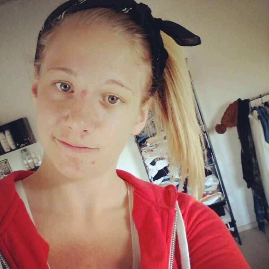 Acne selfie. Photo 6